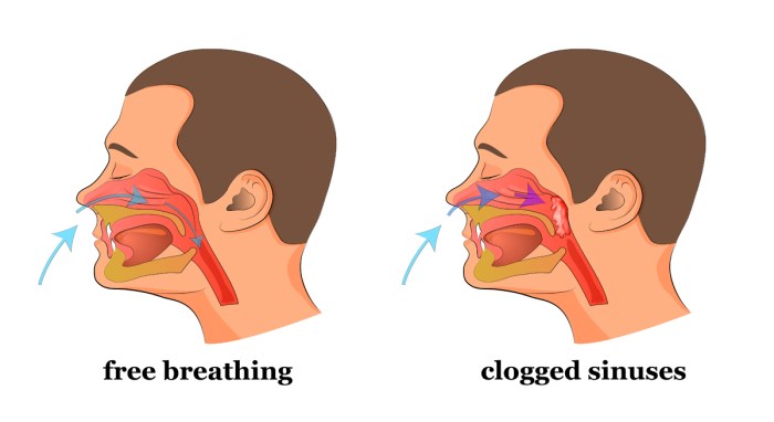 Dry Cough Sore Throat Clogged Ears at Alvera Rollins blog Allergy symptoms sore throat nose bleeds clogged ears