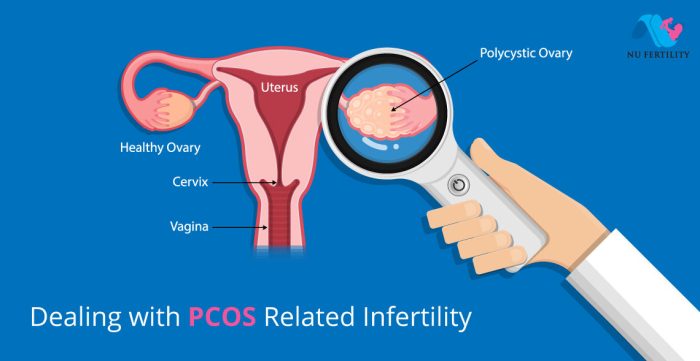 Fertility and PCOS Support - The Healthy Woman Does fertility diet pcos work