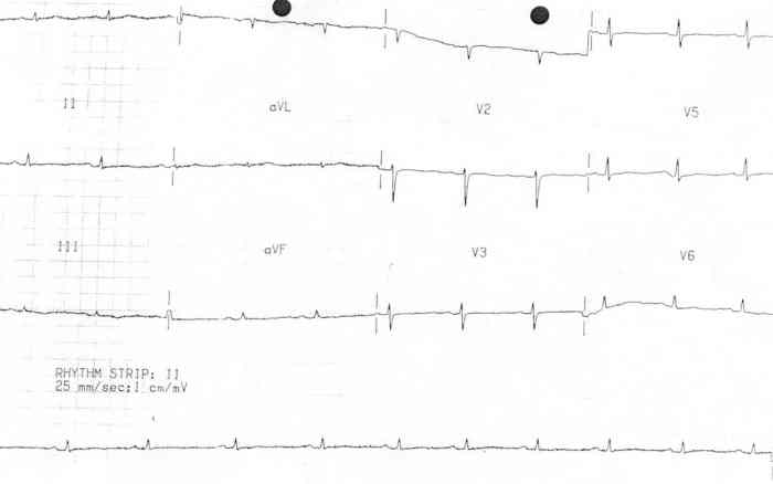Restrictive Cardiomyopathy • LITFL • ECG Library Diagnosis Low carbon sells 435 mw uk solar battery projects totalenergies