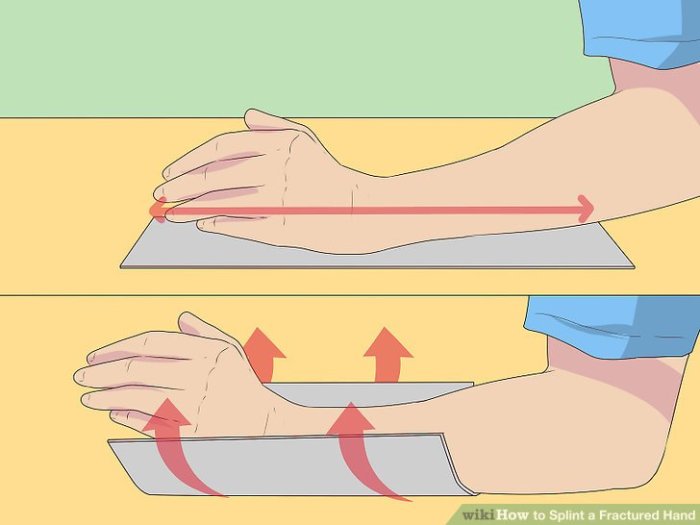 4 Ways to Splint a Fractured Hand - wikiHow Angels put chris taylor fractured hand il
