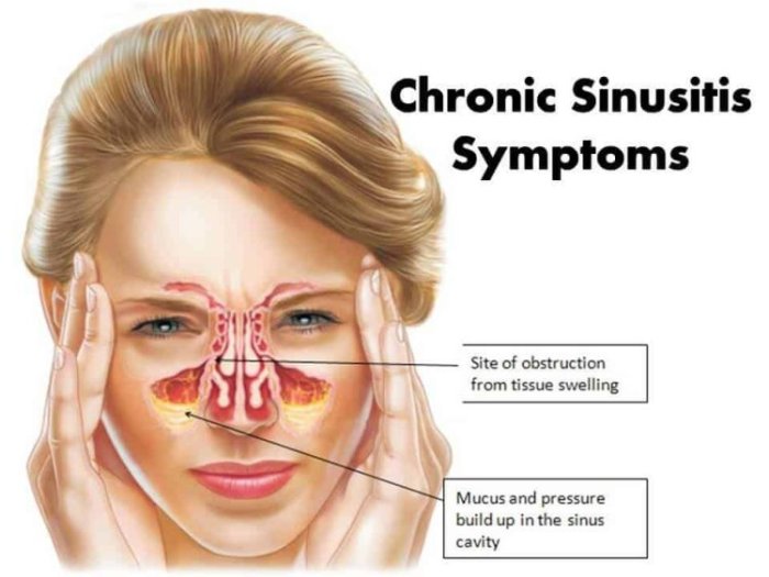 Is it COVID, Allergies, the Flu or a Cold? Here’s How to Tell the ... Allergy symptoms sore throat nose bleeds clogged ears