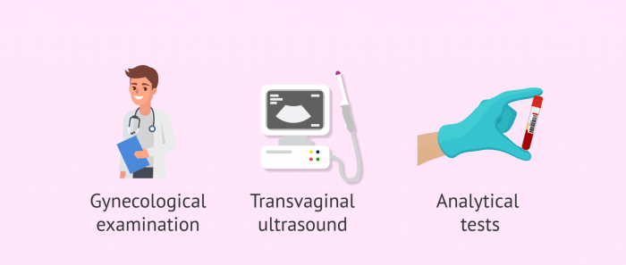 Diagnosis of ovarian cysts Ovarian cyst diagnosis treatment