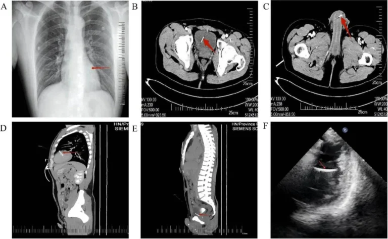 Medical Mystery Unfolds as Doctors Discover Multiple Metallic Foreign Bodies Lodged Within Patient Anatomy