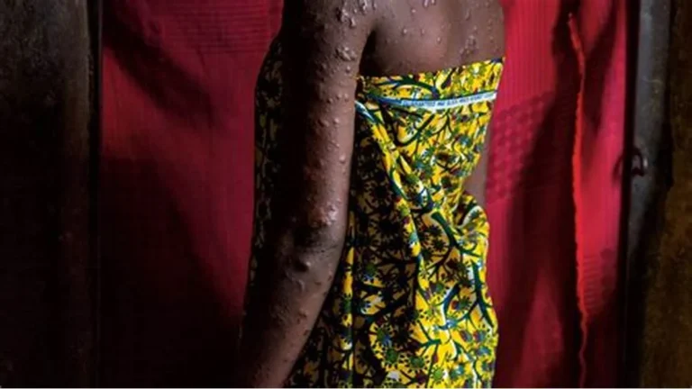 WHO Reports Active Mpox Transmission Across 11 African Nations with Madagascar at the Epicentre
